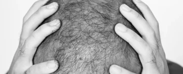 عقار جديد يعيد إنبات الشعر ويمنح أملا لملايين الصلع