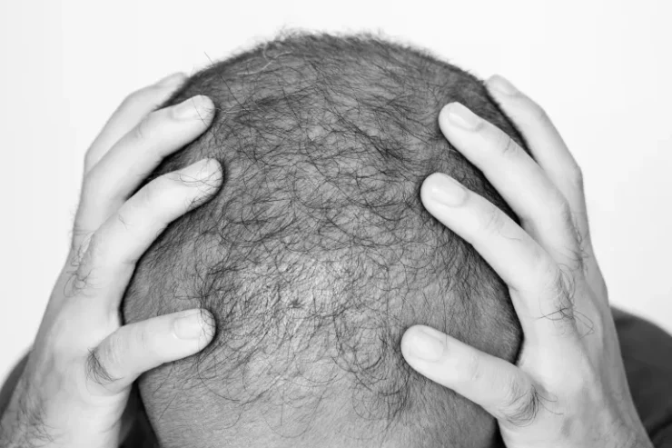 عقار جديد يعيد إنبات الشعر ويمنح أملا لملايين الصلع